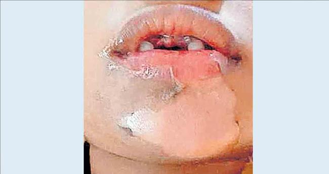 കു​ഞ്ഞി​ന് പൊ​ള്ള​ലേ​റ്റ സം​ഭ​വം; അ​ങ്ക​ണ​വാ​ടി ഹെ​ല്‍­​പ്പ​ര്‍­​ക്കെ­​തി​രേ കേ­​സെ­​ടു​ത്തു