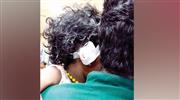 തെ​രു​വു​നാ​യ ക​ടി​ച്ചെ​ടു​ത്ത മൂ​ന്ന് വ​യ​സു​കാ​രി​യു​ടെ ചെ​വി വ​ച്ചു​പി​ടി​പ്പി​ച്ചു