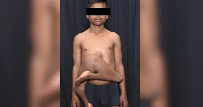 കൗ​മാ​ര​ക്കാ​ര​ന്‍റെ വ​യ​റി​നോ​ട് ചേ​ര്‍​ന്ന് തൂ​ങ്ങിനി​ന്നി​രു​ന്ന അ​ധി​ക കാ​ലു​ക​ള്‍ നീ​ക്കംചെ​യ്ത് എ​യിം​സ് ഡോ​ക്ടർമാർ