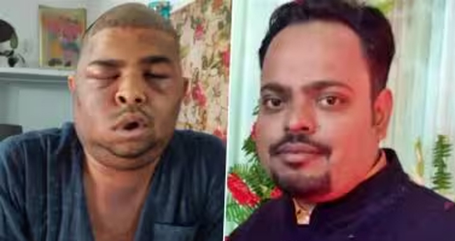 യുപിയിൽ മുടിമാറ്റിവയ്ക്കൽ ശസ്ത്രക്രിയയ്ക്കിടെ പിഴവ്;  രണ്ട് എൻജിനിയർമാർ മരിച്ചു