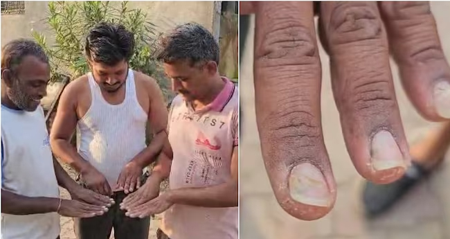 മുടികൊഴിച്ചിലിനു പിന്നാലെ ബുൽധാനയിൽ  നഖ പ്രശ്നവും!