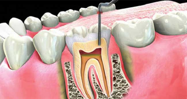 റൂട്ട് കനാൽ ചികിത്സ - തെറ്റിദ്ധാരണകൾ ഒഴിവാക്കാം