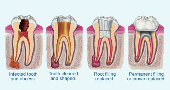 റൂട്ട് കനാൽ ചികിത്സ - എപ്പോൾ, എങ്ങനെ‍?