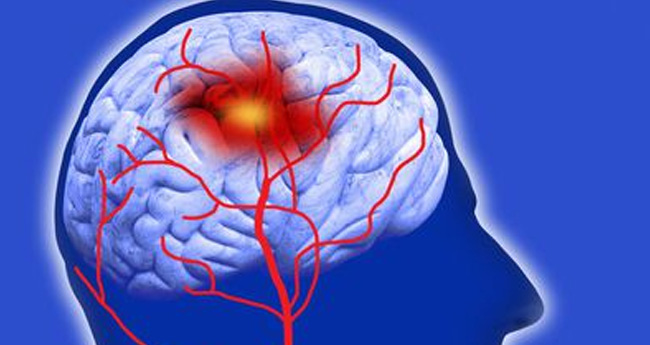 സ്ട്രോക് സൂചന അറിഞ്ഞാൽ ചികിത്സ വൈകിപ്പിക്കരുത്