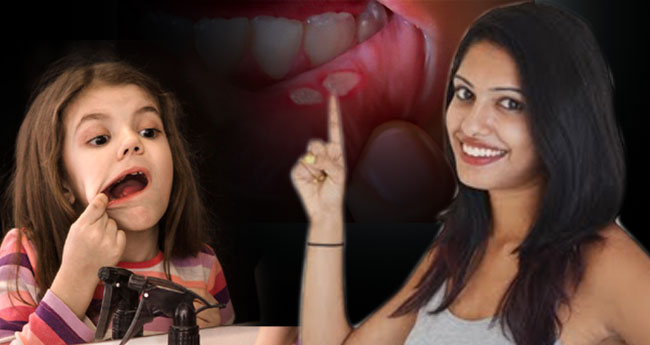 വാ​യ്പുണ്ണ് ( മൗത്ത്  അ​ൾ​സ​ർ) എ​ങ്ങ​നെ ചി​കി​ത്സി​ക്കാം?